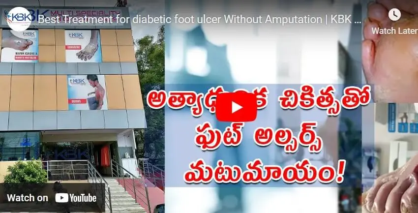 Best Treatment for Diabetic Foot Ulcer without Amputation